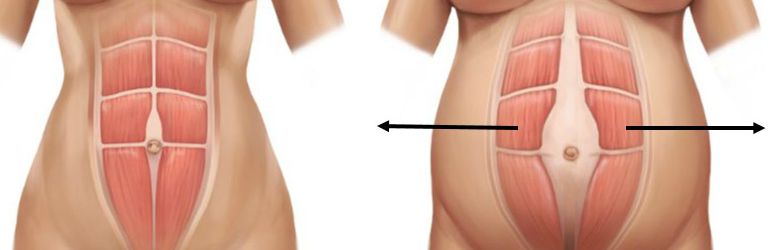 Diástasis Ser-Pélvica